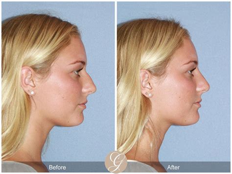 how long does non surgical rhinoplasty last